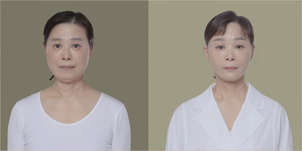Soonplus 手术前后对比照片