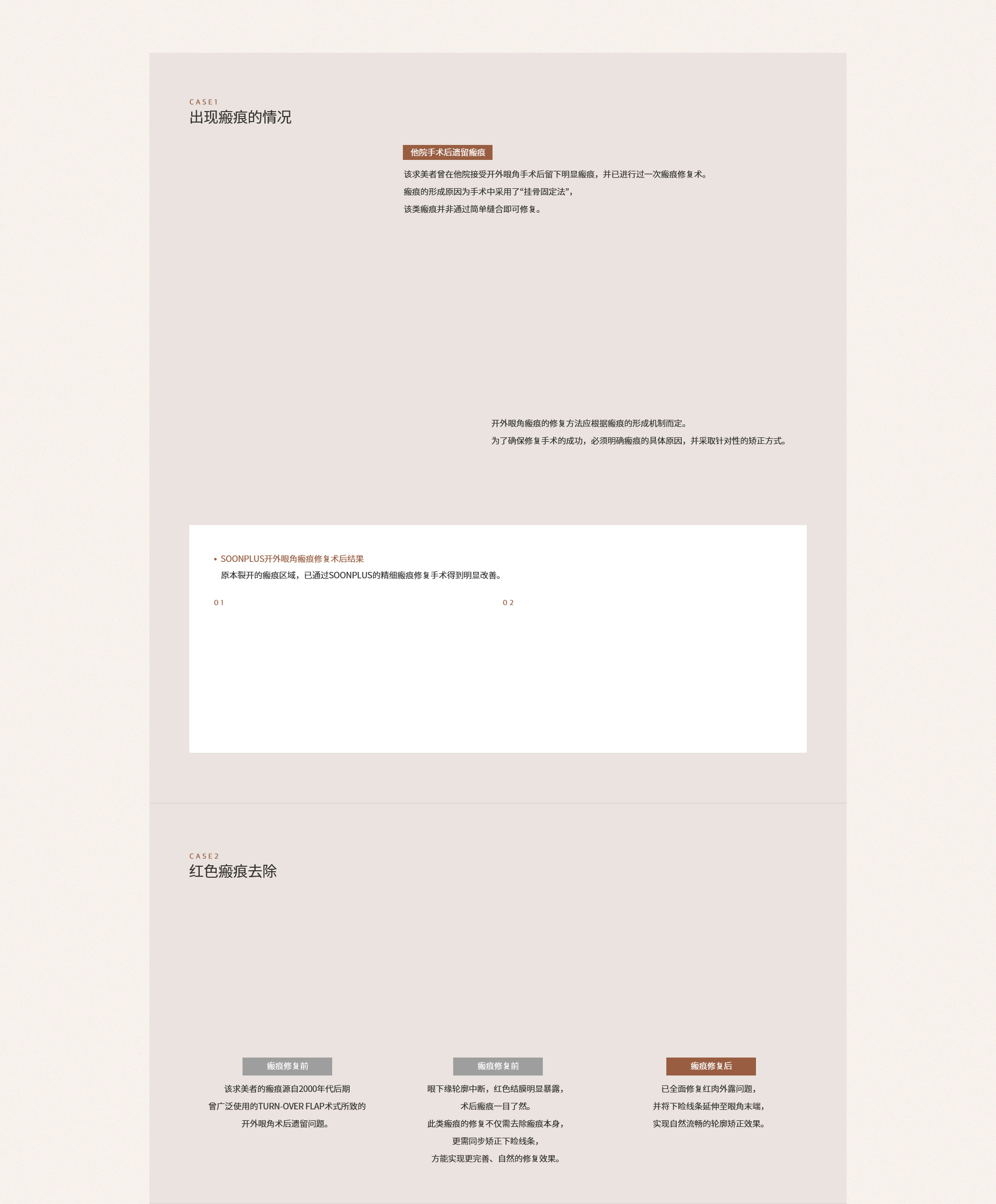 뒤트임 재수술은 이미 흉터가 생긴 부위를 다시 재수술하는 것이기 때문에 어설프게 수술했다간 새로운 흉터가 발생할 수 있으므로 의료진의 실력이 무엇보다 중요합니다.