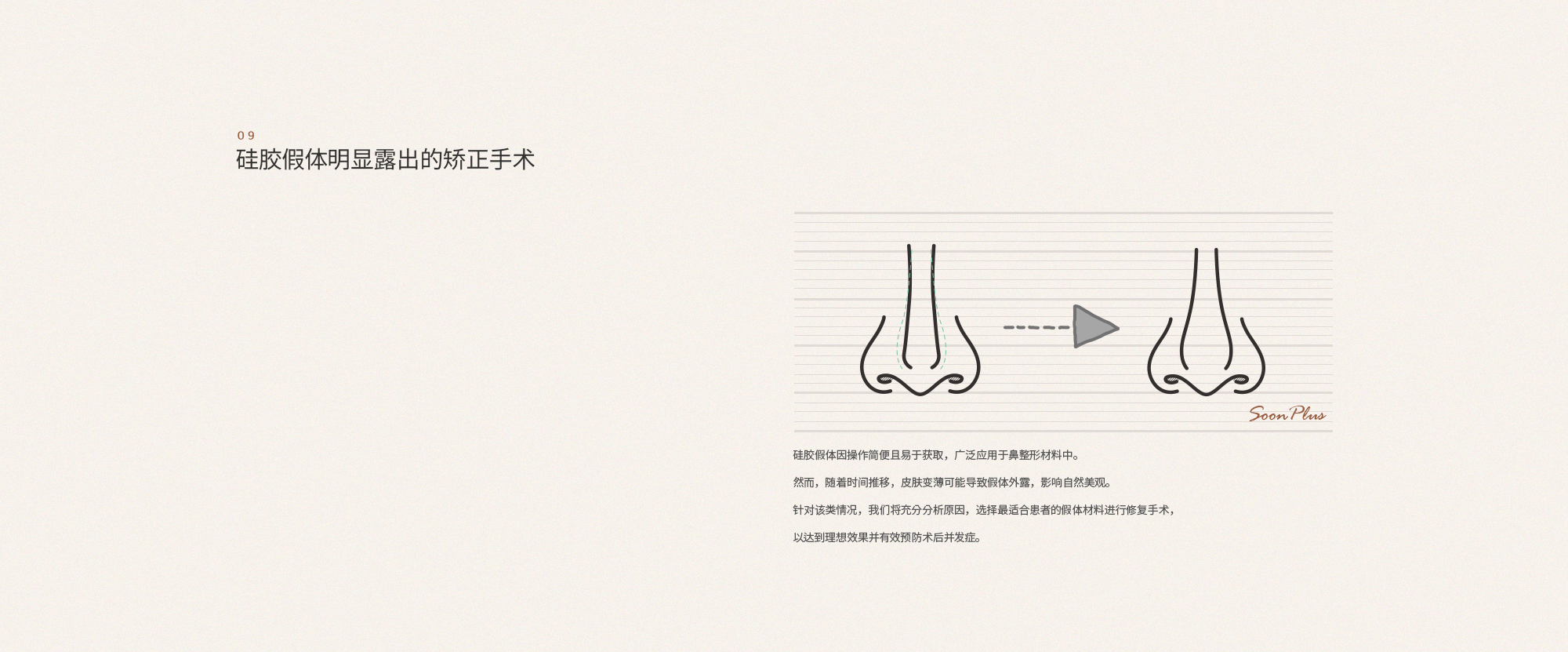 코 재수술
